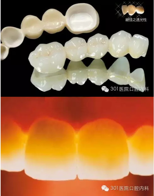 贵金属假牙(贵金属假牙可以做核磁共振)