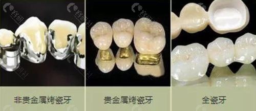 贵金属烤瓷牙多少钱一颗(贵金属烤瓷牙多少钱一颗?)