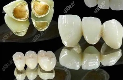 贵金属烤瓷牙多少钱一颗(门牙为什么不建议做全瓷牙)